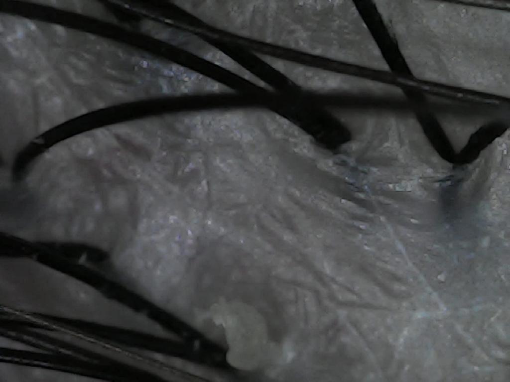 cou-cabeludo-depois Couro Cabeludo - Depois